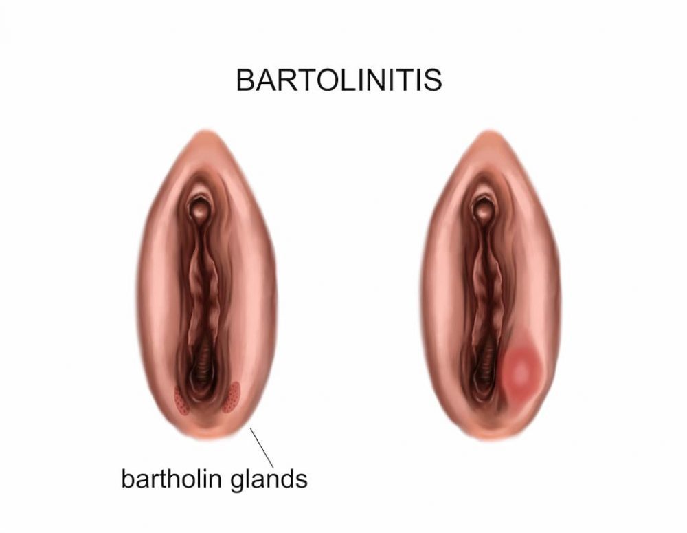 bartholin absesi